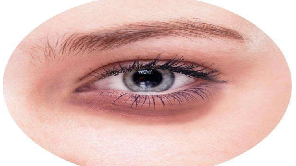 What causes dark circles around the eyes in adults