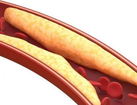 3 steps to treat Hyperlipidemia