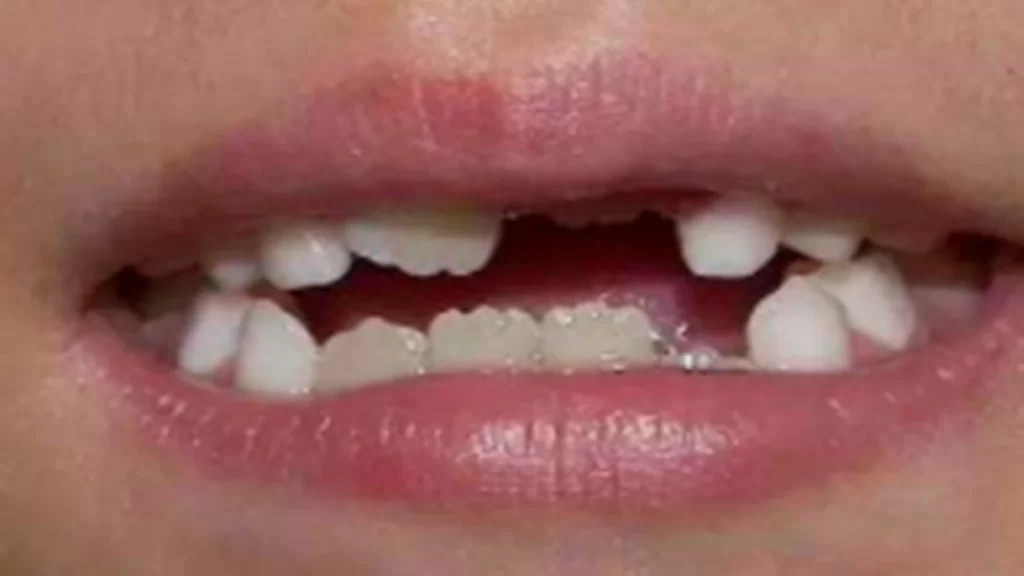 What are the precautions of teeth care 