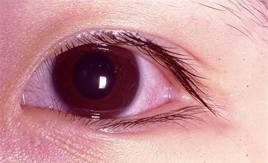 2.Lack of vitamin B2, the signal sent by the eyes: