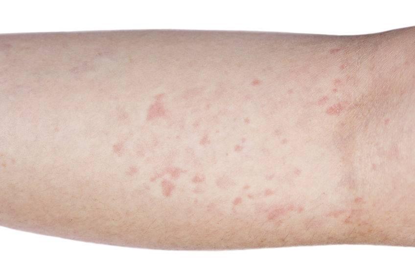 How to cure eczema permanently