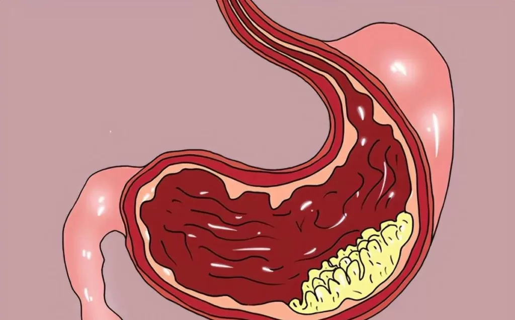    Too much salt can cause premature aging of the stomach: