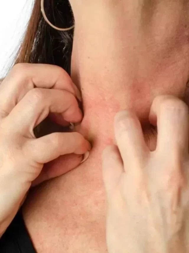 How to cure eczema permanently