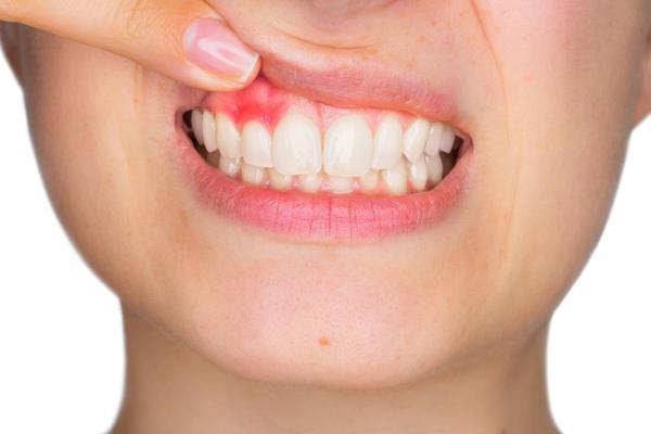 Cause of Bleeding Gums frequent 