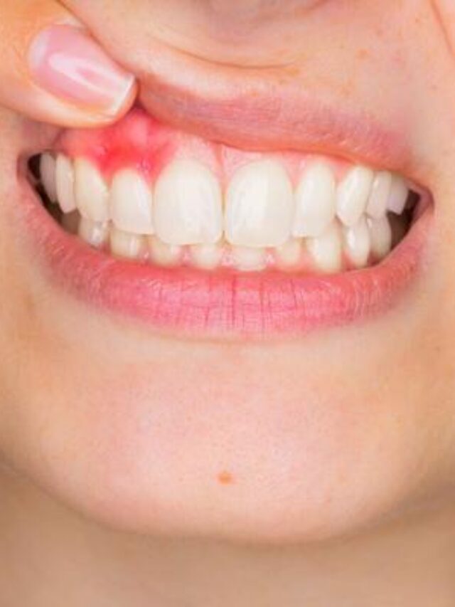 Cause of Bleeding Gums frequently in young age, adult, teenage