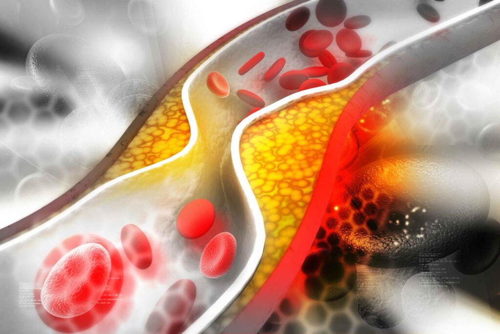  Fourth, reduce blood lipids