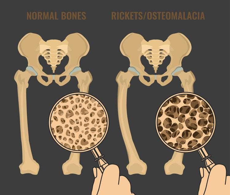 5. Pay attention to bone mass monitoring