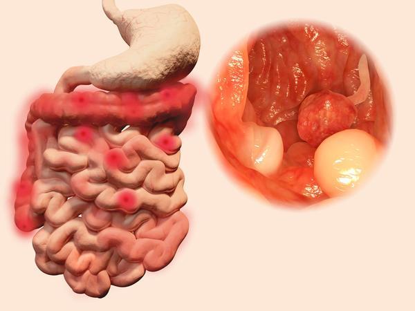 What are the  5 symptoms of bowel polyps?
