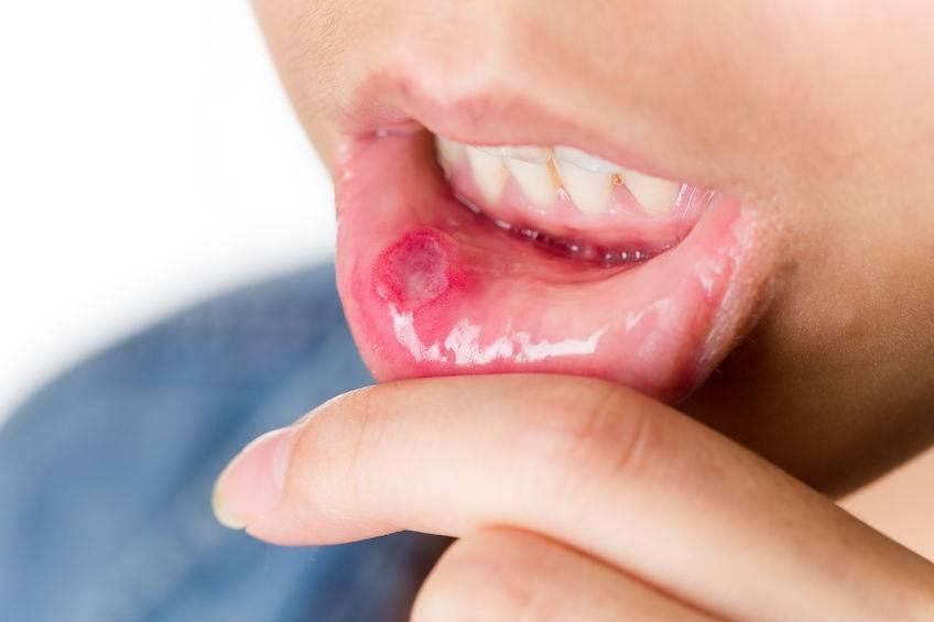 Recurrent oral ulcers