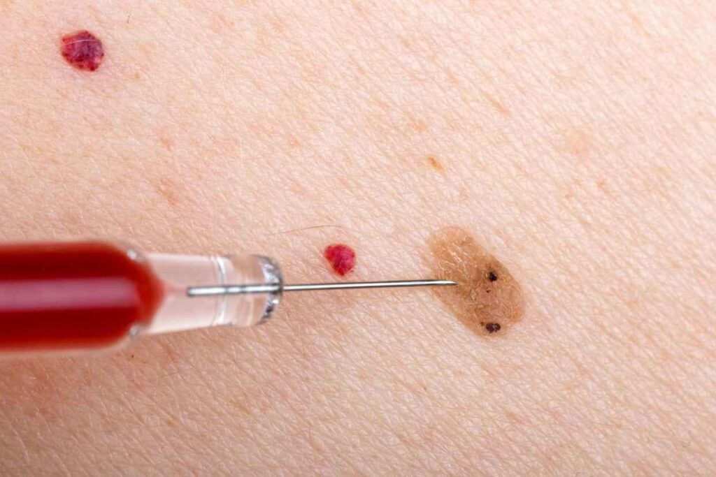 2. Vascular nevus