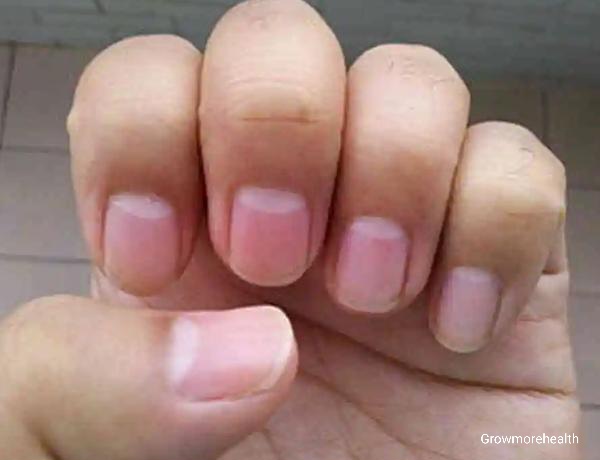 Why do some people have lunula (crescents) on their nails and others don't?